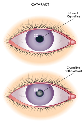 Houston Cataract Surgery Center Brings Attention to Cataract Awareness Month