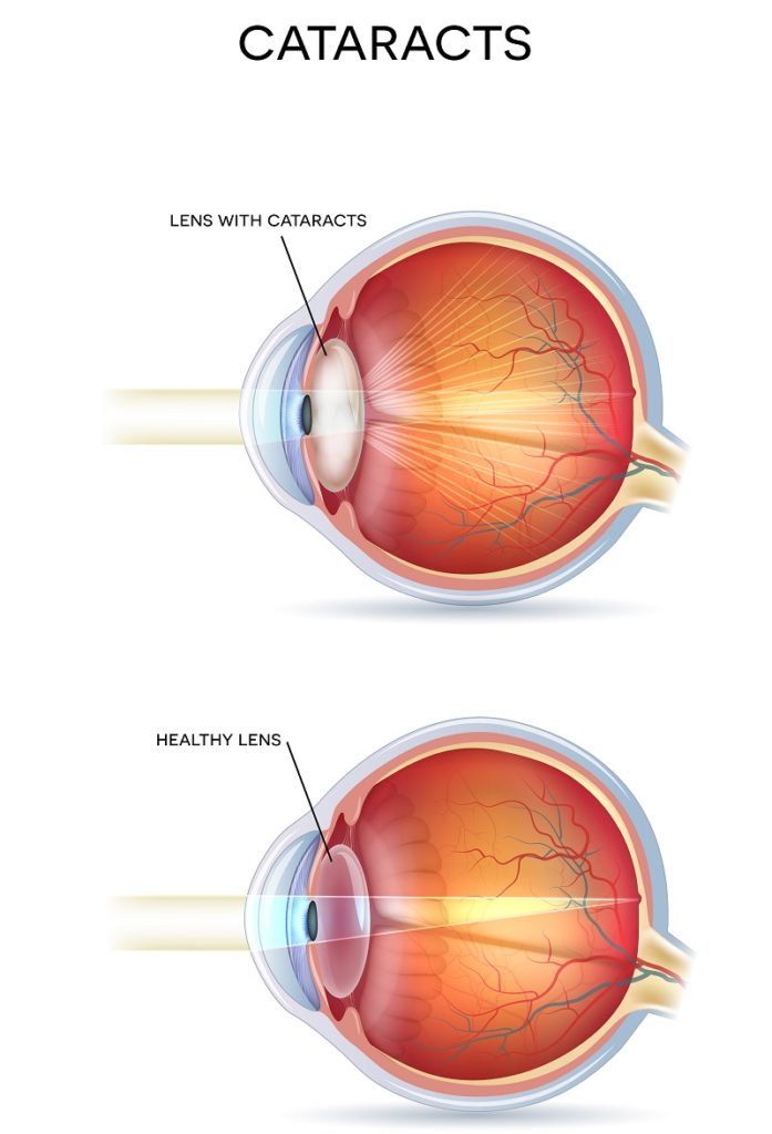 Cataract Awareness Month