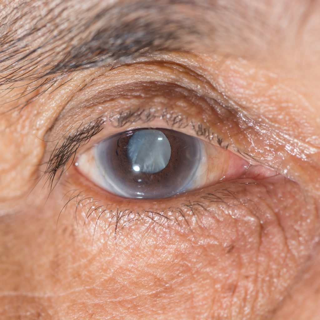 Common Causes of Cataracts: Find Out If You're At Risk