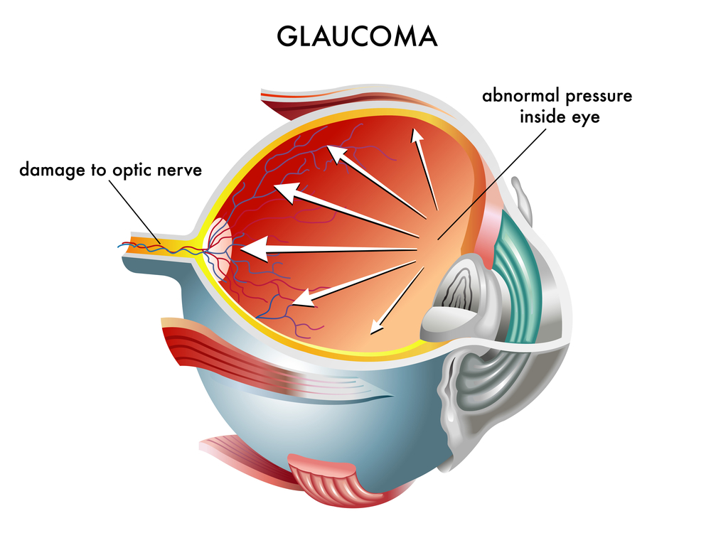 Houston Glaucoma Treatment Specialist