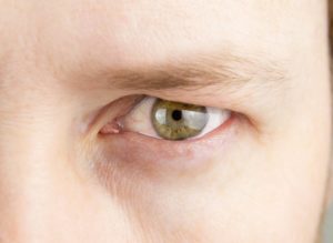 Ptosis: Causes, Symptoms, and Treatment of a Droopy Eyelid