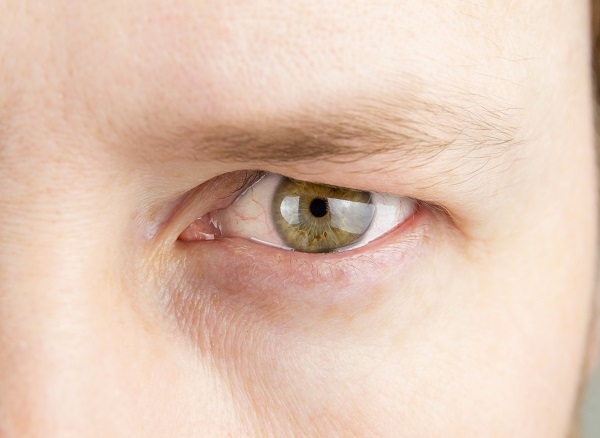 Droopy Eyelid: Causes, Symptoms, and Treatment of Ptosis