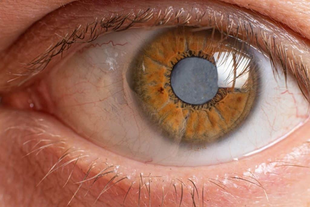 Can You Get Rid of Cataracts Without Surgery?