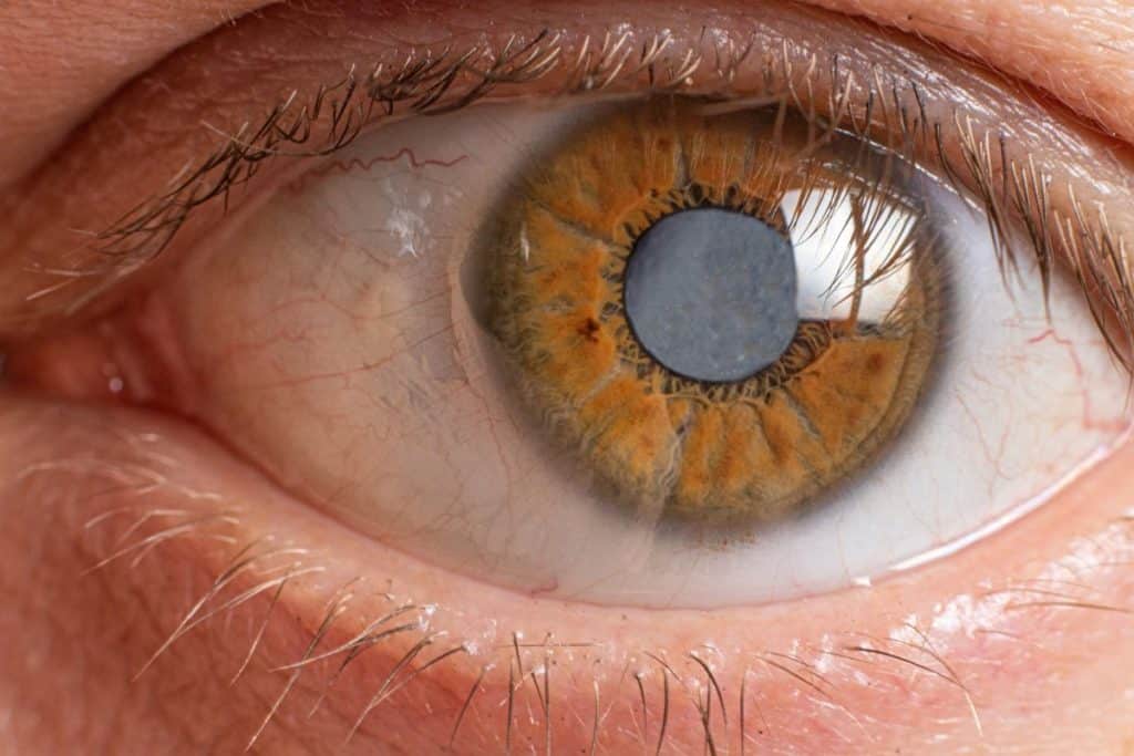 Can You Get Rid of Cataracts Without Surgery? 1 Can You Get Rid of Cataracts Without Surgery?