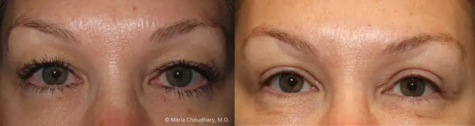 Before and After Upper Bleph 1
