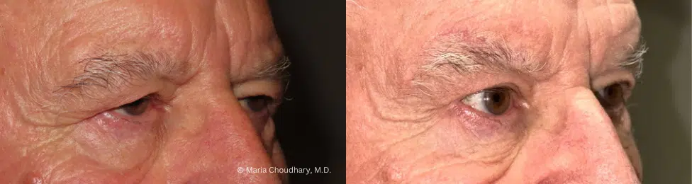 PTOSIS REPAIR