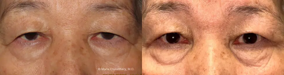 Before and After pper bleph and ptosis repair