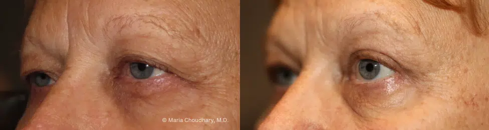 Before and After upper brow ptosis repair and internal brow lift 1