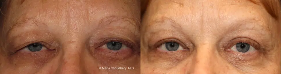 Before and Afterupper brow, ptosis repair and internal brow lift 2