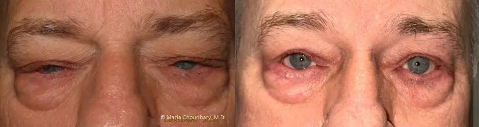 Upper lid blepharoplasty and ptosis repair and right lower lid entropion correction