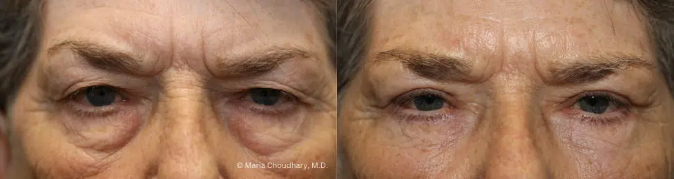 UPPER & LOWER EYELID SURGERY (BLEPHAROPLASTY)