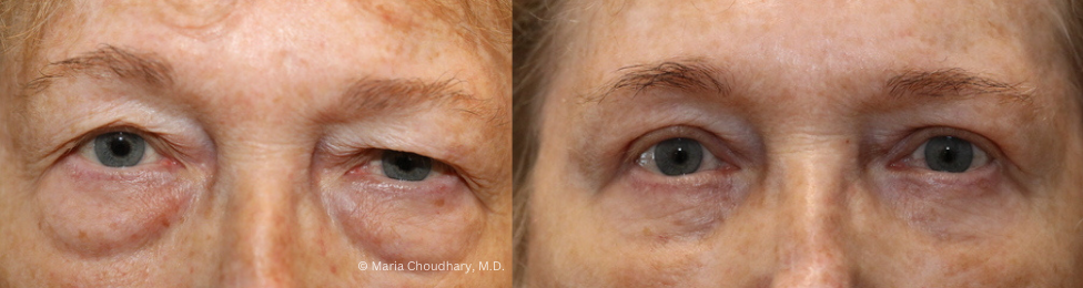 Upper Blepharoplasty Lower Blepharoplasty and Temporal Brow Lift