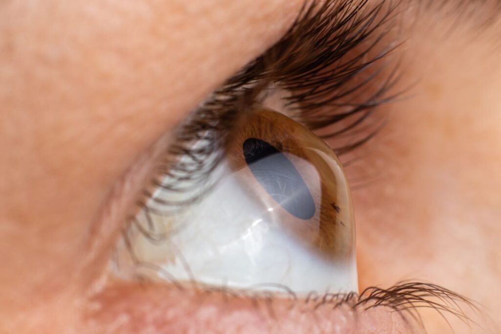 Houston Keratoconus Specialist