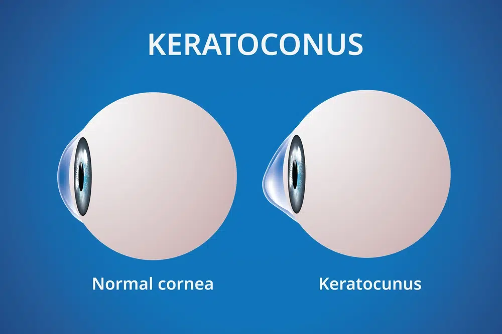 Houston Keratoconus Specialists 1 Keratoconus specialist Houston