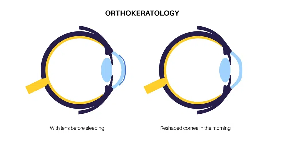 Myopia Control for Children 6 Ortho-K for kids Houston